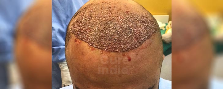 Пересадка волос в Индии от лучшего дерматолога